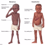 difference-between-kwashiorkor-and-marasmus