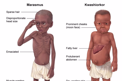 difference-between-kwashiorkor-and-marasmus
