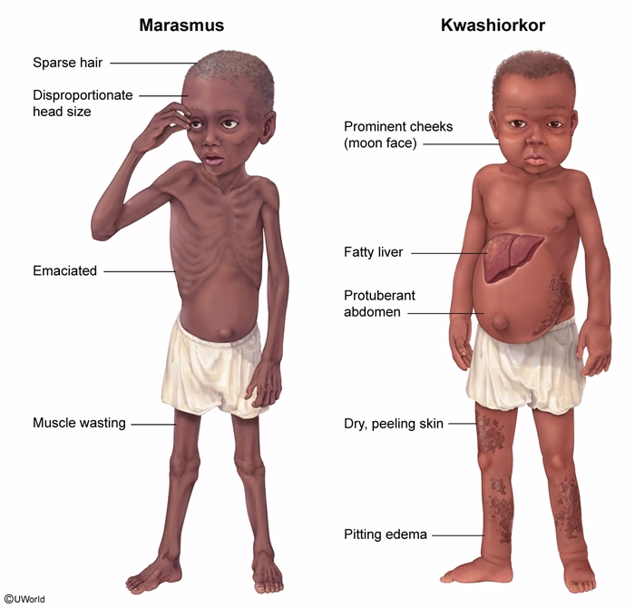 difference-between-kwashiorkor-and-marasmus